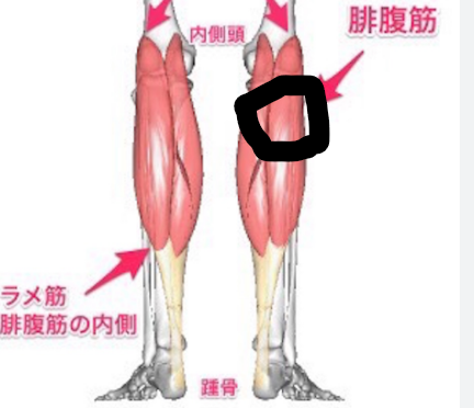 ふくらはぎの筋肉解剖図 - 右脚の腓腹筋内側頭を黒丸で示したテニスレッグの初期症状部位