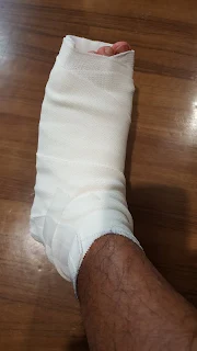 疲労骨折による包帯を巻いた足