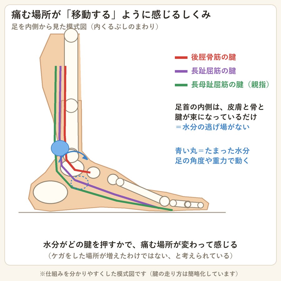 足を内側から見た模式図。内くるぶしの後ろを後脛骨筋・長趾屈筋・長母趾屈筋の3本の腱が束になって通り、たまった水分が動くと押される腱が変わる